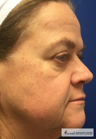 Restylane® Silk: Patient 13 - After 3