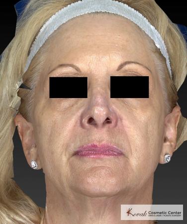 Sculptra®: Patient 5 - Before 4