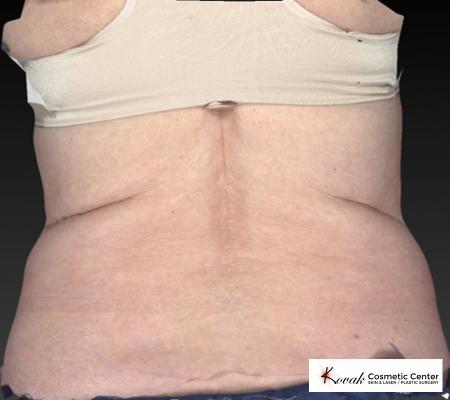 CoolSculpting®: Patient 13 - Before and After 5