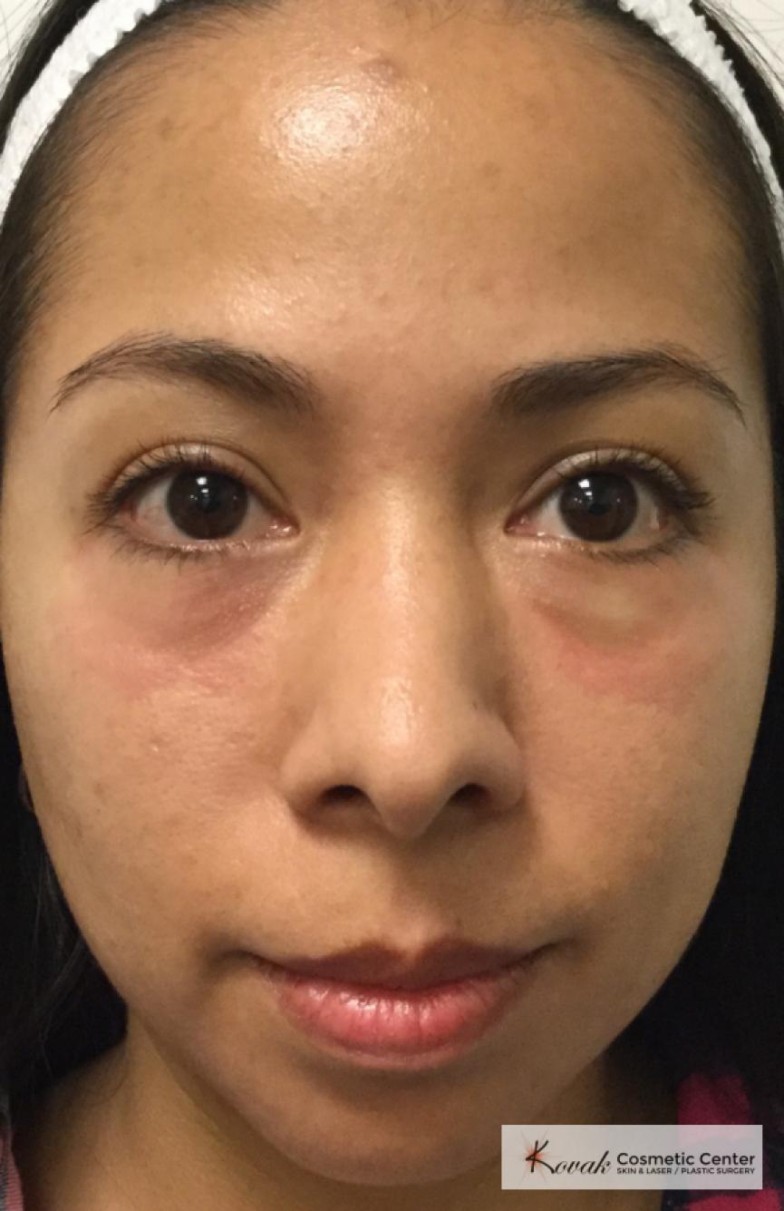 Injectables: Patient 1 - Before 