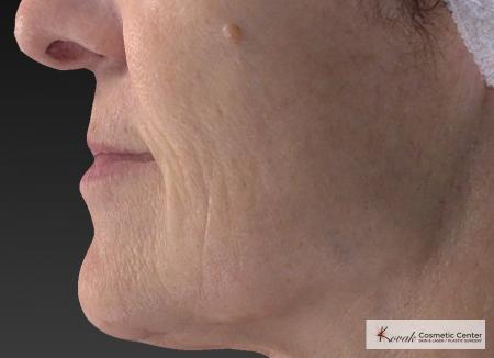 Injectables - Mouth: Patient 8 - After Image 3