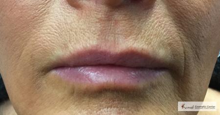 Lip Augmentation: Patient 4 - After  