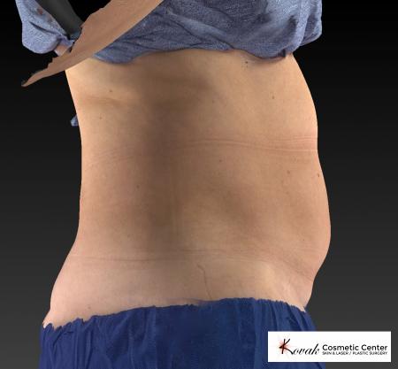 CoolSculpting®: Patient 10 - Before and After 5