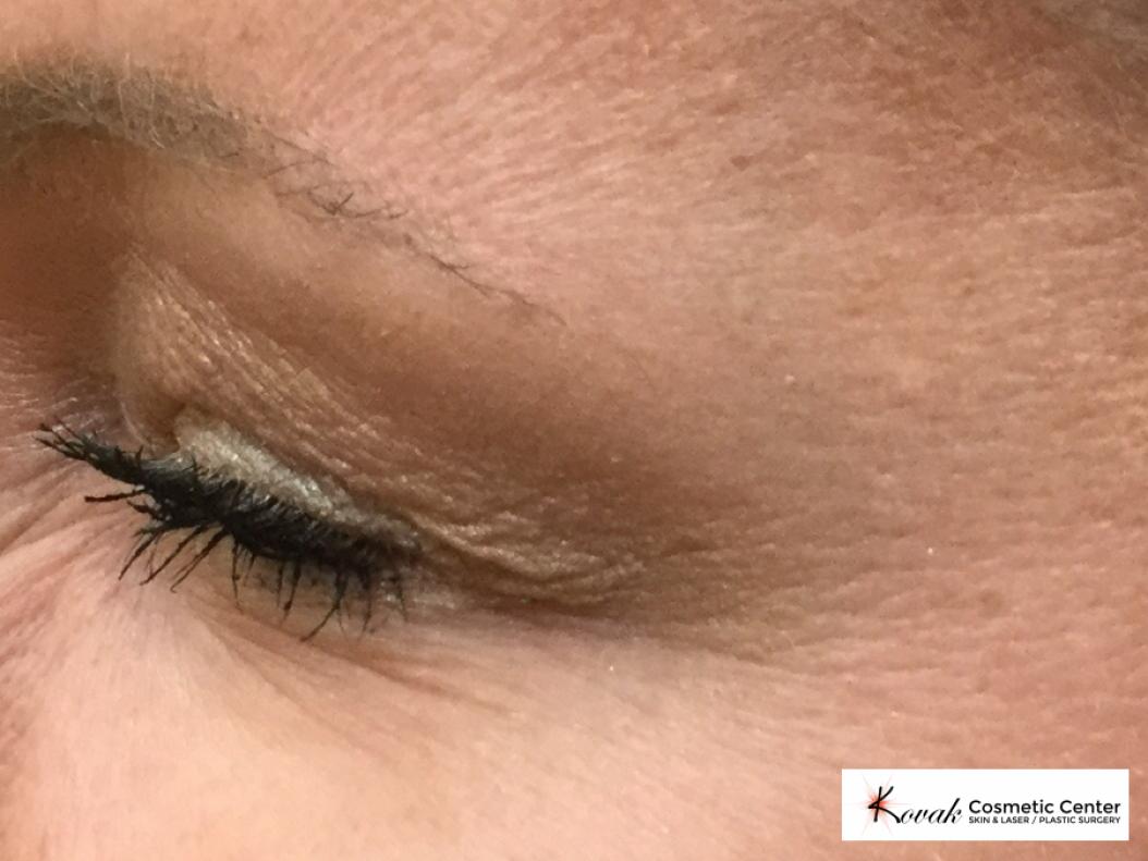 Botox for the eyes on a 40 year old woman - After  