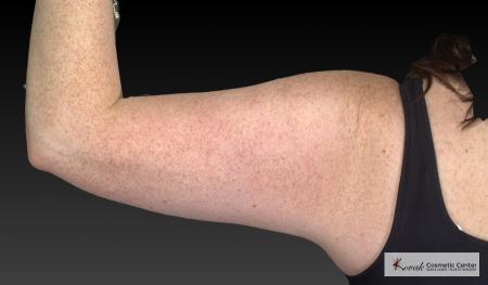 CoolSculpting®: Patient 24 - After