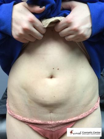 Laser Liposuction of the abdomen on a 28 year old female - Before 1