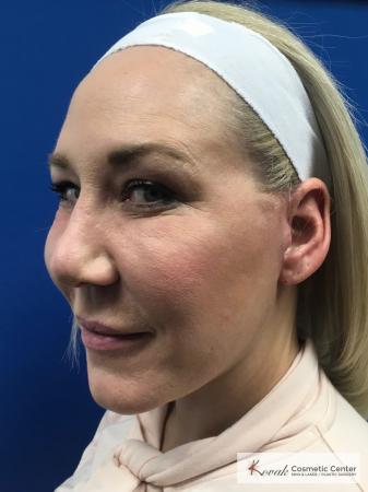 Neck Lift: Patient 3 - After 2