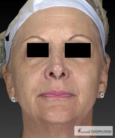 Sculptra®: Patient 5 - After 4