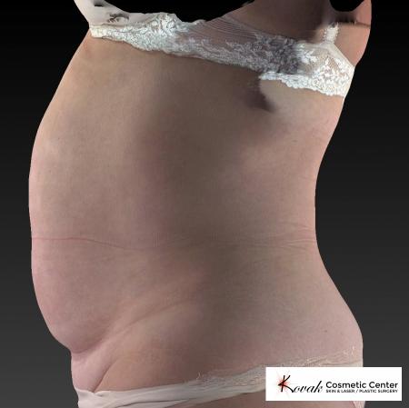 CoolSculpting®: Patient 11 - After 3