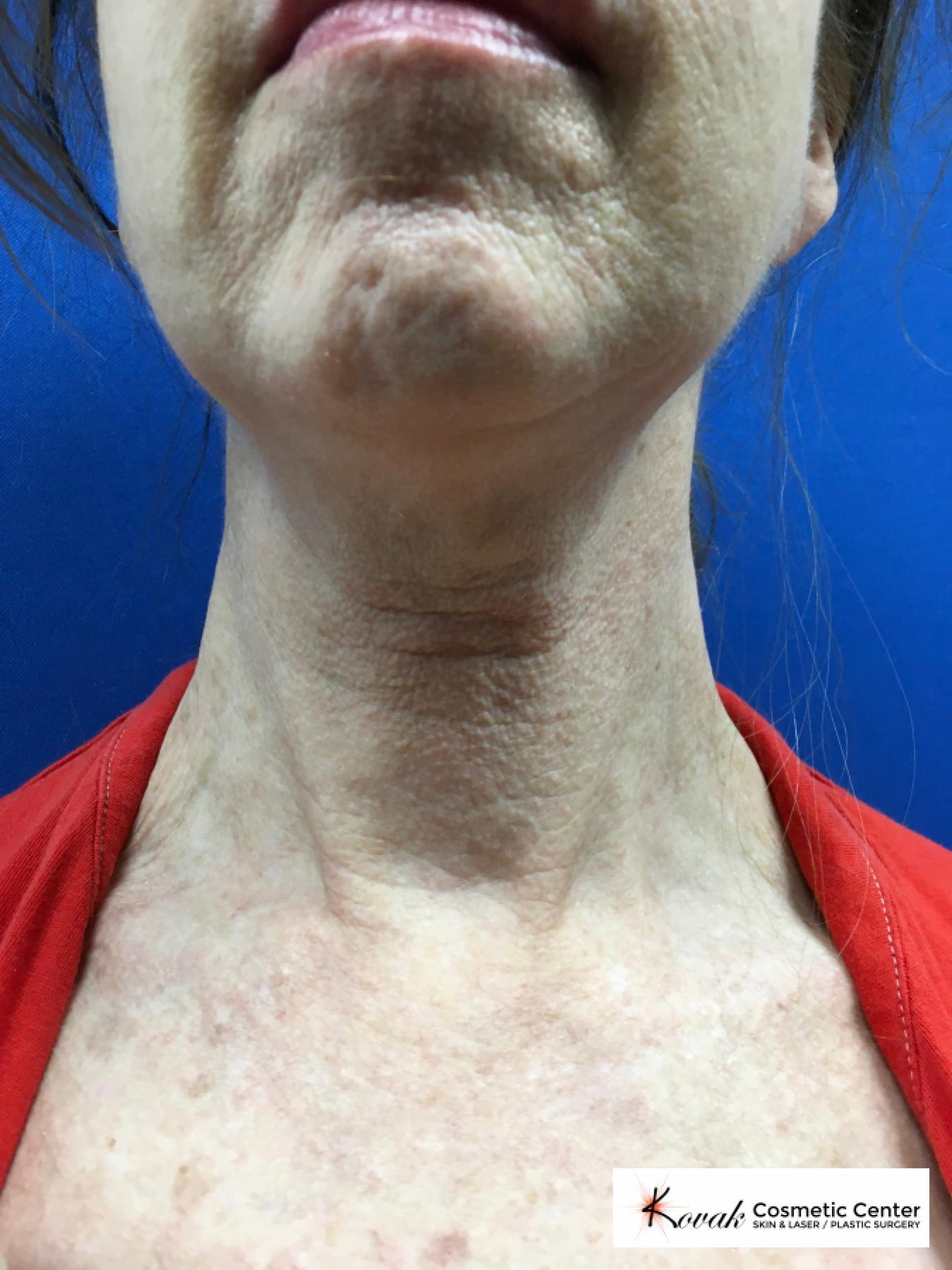 Microneedling on the neck of a 61 year old female using Scarlet - Before 