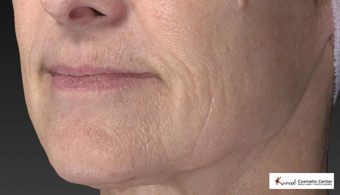 Restylane® Silk: Patient 2 - After 4