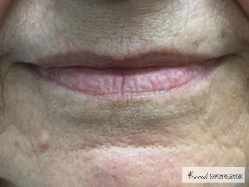 Restylane Silk for lines around the mouth on a 61 year old female - After  