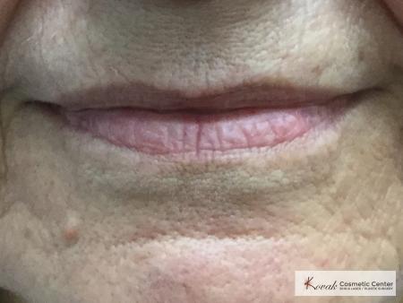 Restylane Silk for lines around the mouth on a 61 year old female - After 1