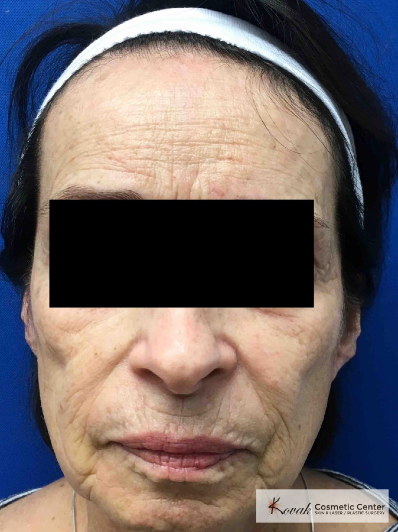 Sculptra for facial volume on a 71 year old female - Before 