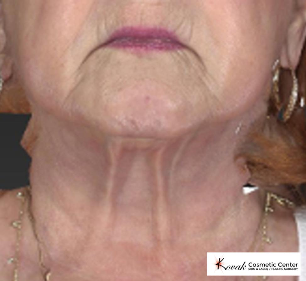 CoolSculpting®: Patient 5 - After  