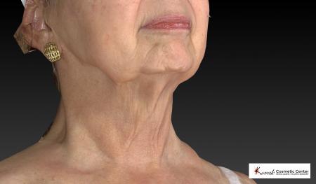 Kybella: Patient 3 - After Image 2