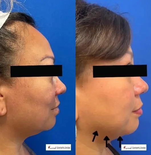 Jaw Sculpting: Patient 1 - Before and After  