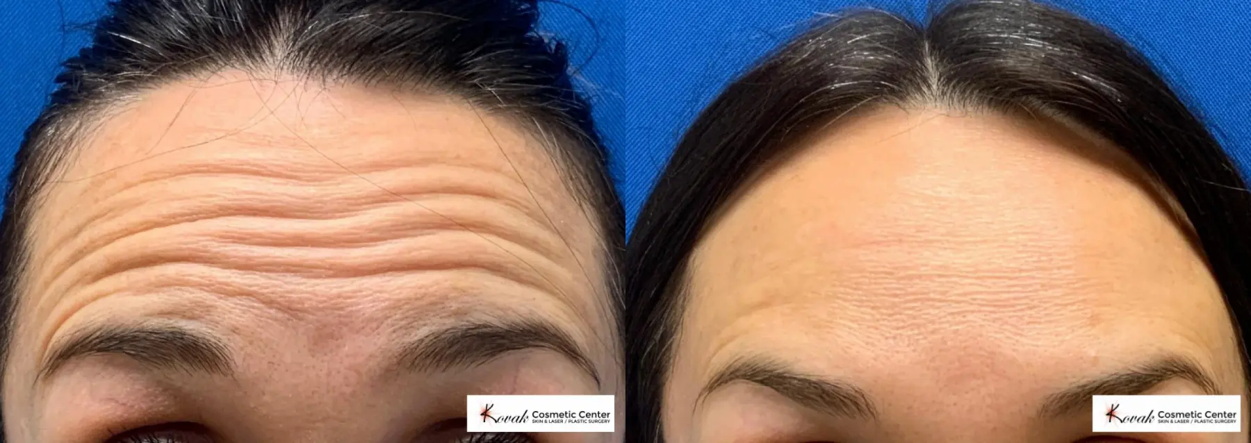 Neurotox Treatment using Jeuveau for forehead wrinkles on a 40 year old female - Before and After  