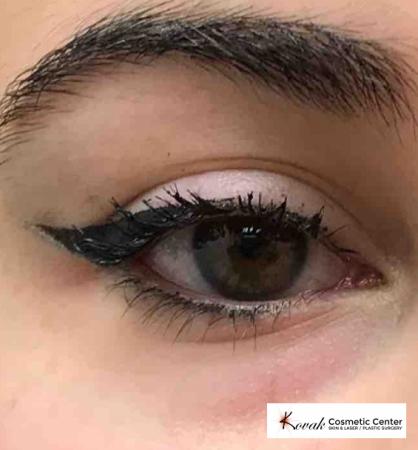 Eye Treatments: Patient 1 - Before 1