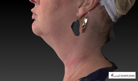 Kybella: Patient 1 - After Image 4