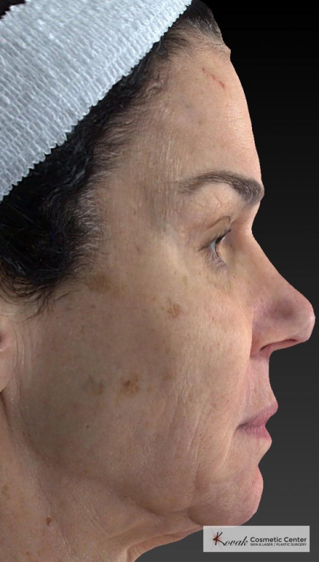 Halo™: Patient 3 - Before 