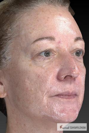 Tyte And Bryte – Face: Patient 6 - Before and After Image 5