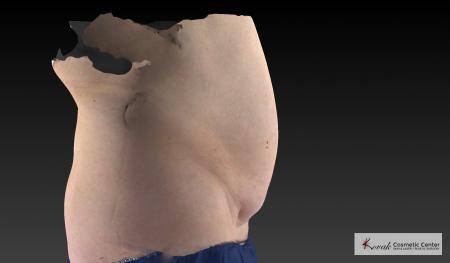 CoolSculpting®: Patient 21 - Before