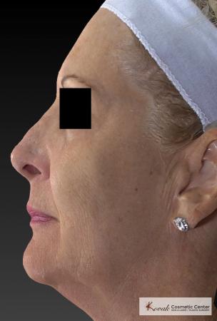Sculptra®: Patient 5 - After 2