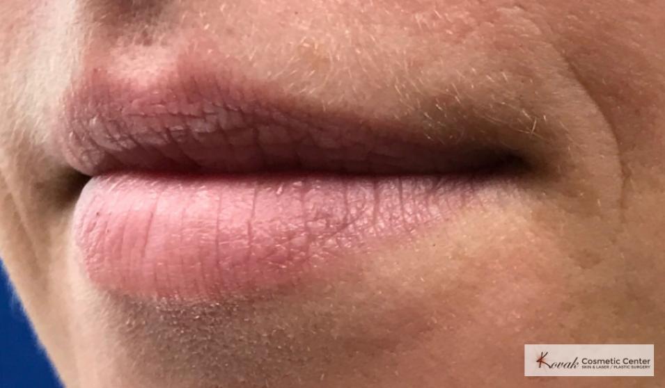 Lip Augmentation: Patient 2 - Before 