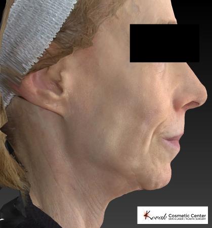 Sculptra®: Patient 1 - Before 2