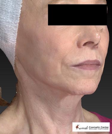 Sculptra®: Patient 1 - After 3