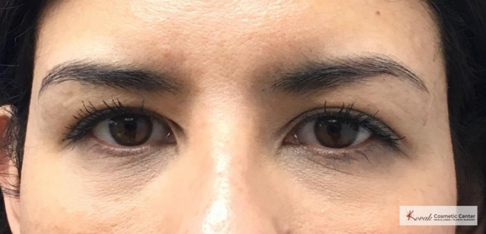 Injectables - Face: Patient 4 - After  