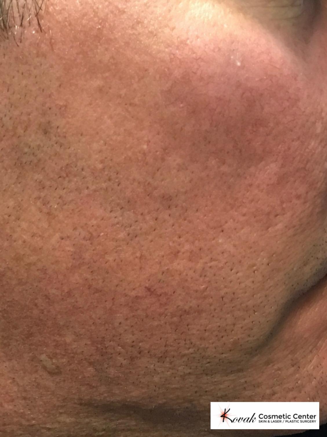 Acne Scars treated with Juvederm on 45 year old male - After  