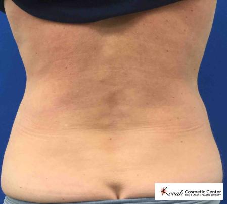 EMSCULPT®: Patient 2 - After 4