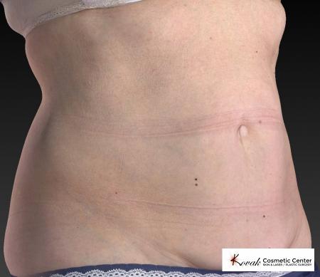 CoolSculpting®: Patient 12 - After 2