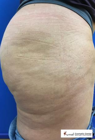 Cellulite Reduction: Patient 4 - After 3