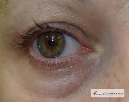 Injectables - Face: Patient 2 - Before 