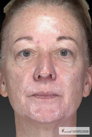 Tyte And Bryte – Face: Patient 6 - Before Image 1