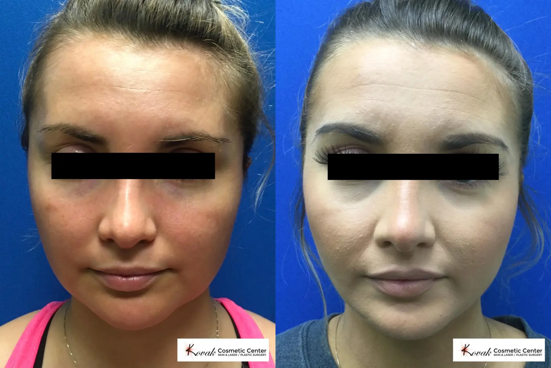 Laser Liposuction of the jawline on a 25 year old female patient - Before and After  