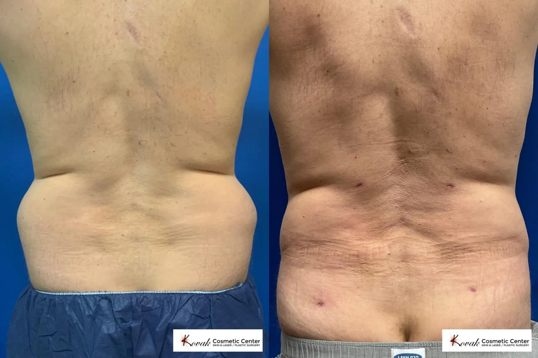 Laser Liposuction using the VLR technique on a 59 year old male - Before and After  