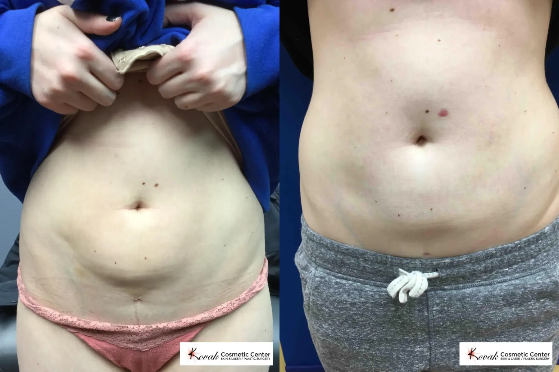Laser Liposuction of the abdomen on a 28 year old female - Before and After  