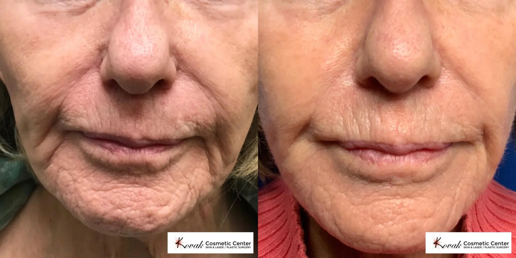 Laser resurfacing using the Halo on a 71 year old female - Before and After  