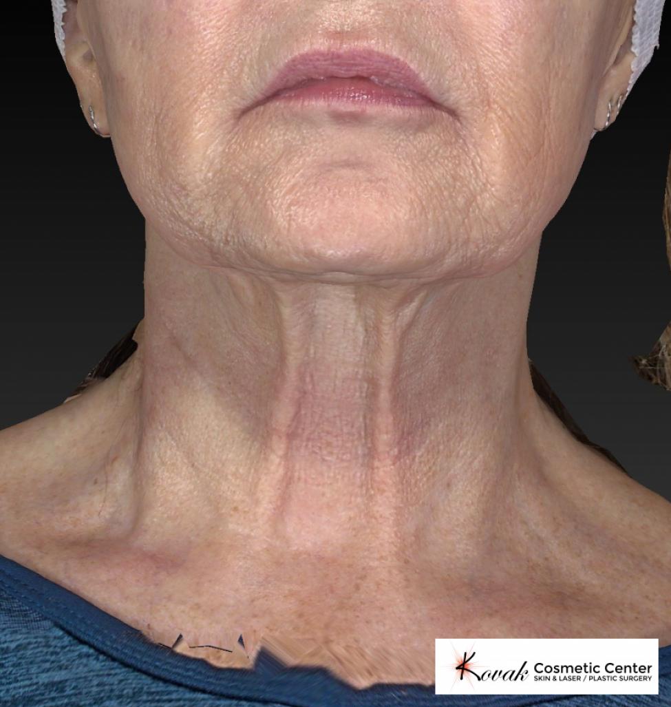 Kybella: Patient 2 - After  