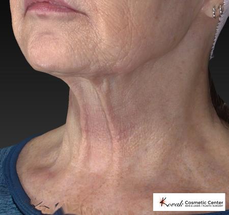 Kybella: Patient 2 - After Image 3