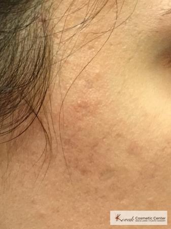 Acne Scars treated with Venus Viva on 28 year old woman - After Image 1