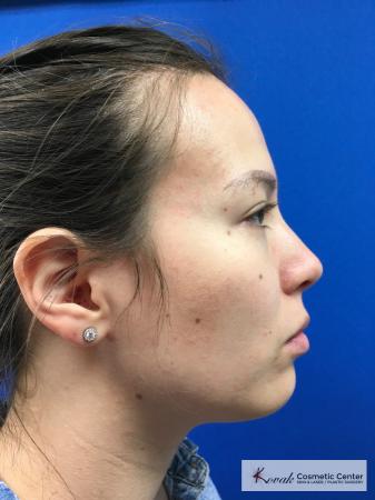 Restylane® Lyft: Patient 2 - Before 3