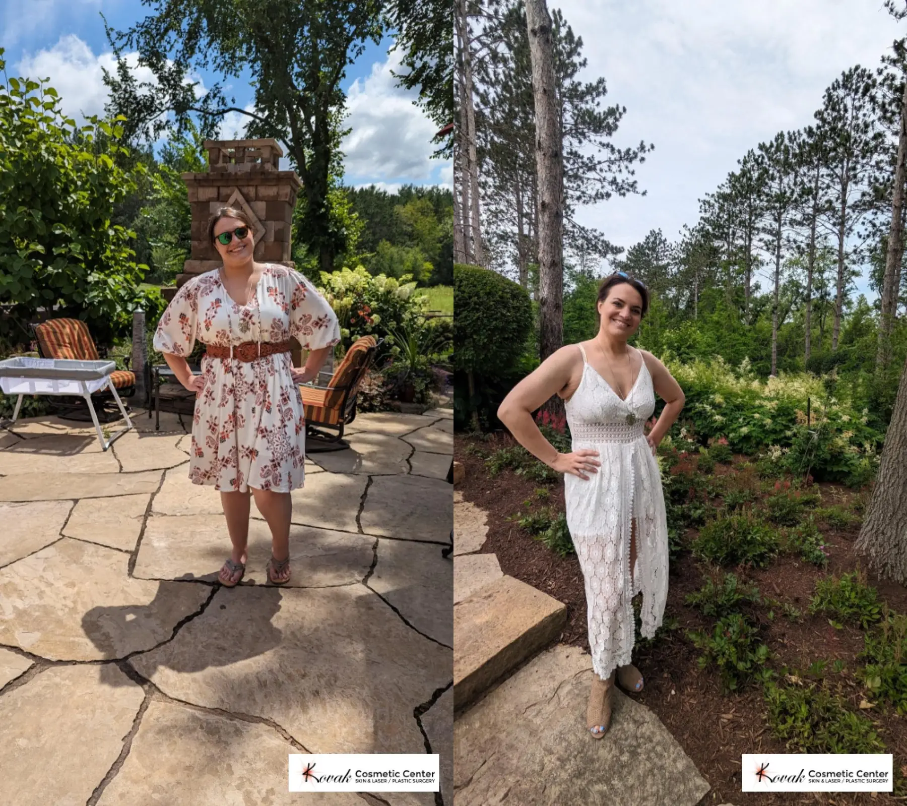 Medical Weight Loss Program: Patient 1 - Before and After 1