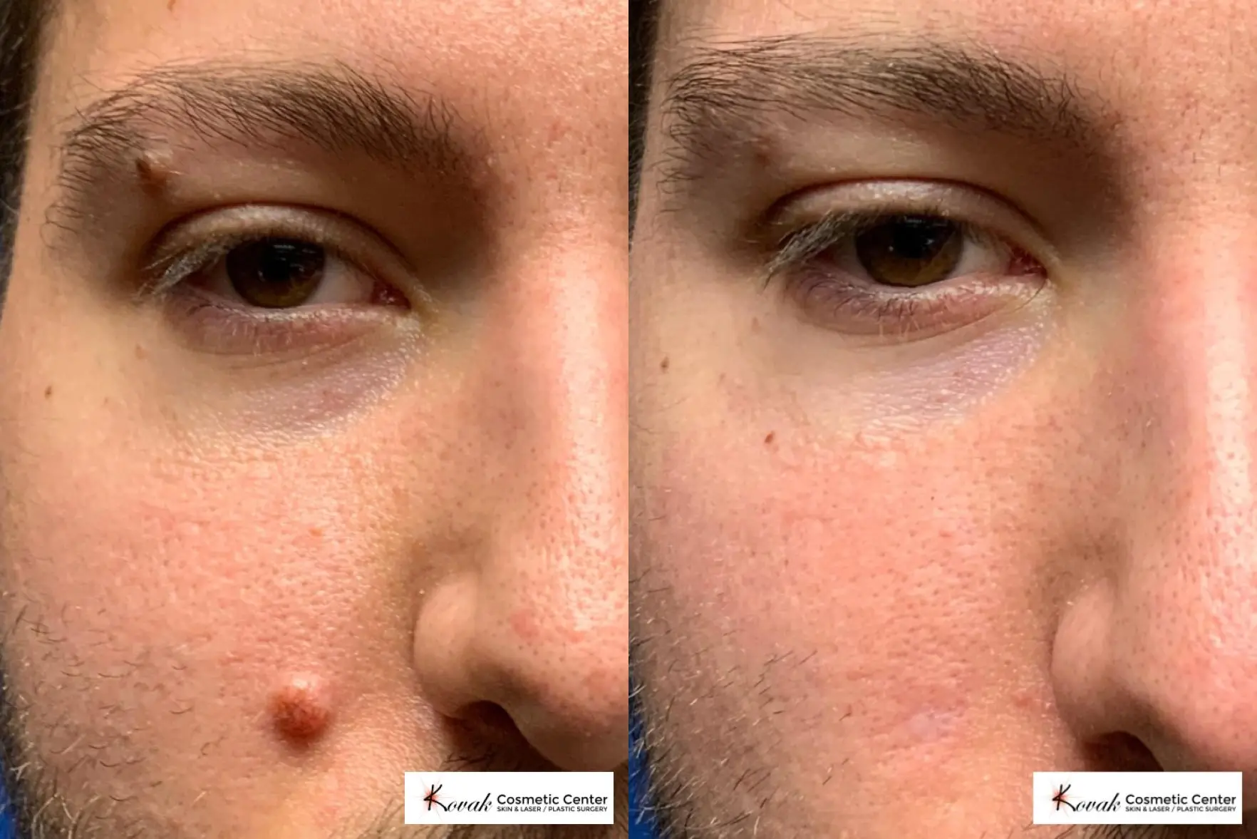 Mole Removal on a 26 year old male - Before and After  