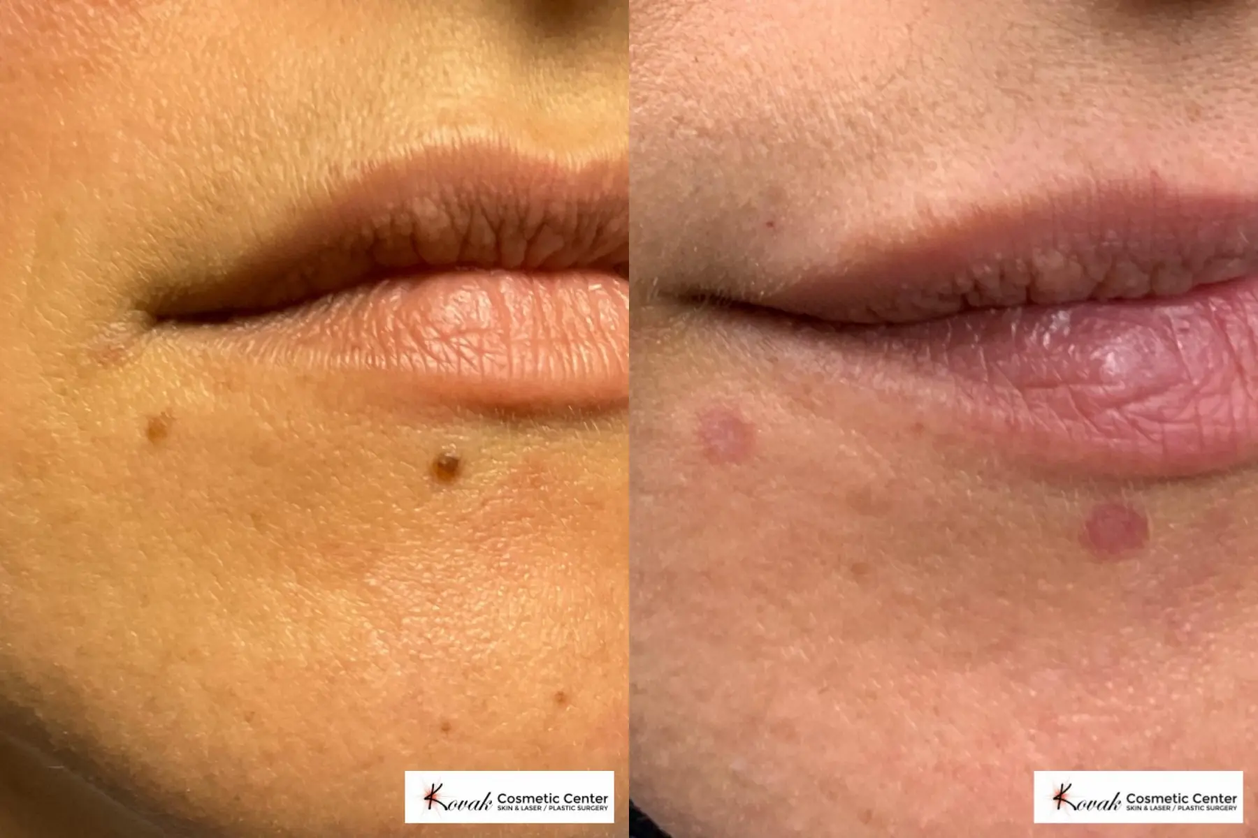 Mole Removal on a 38 year old female - Before and After  
