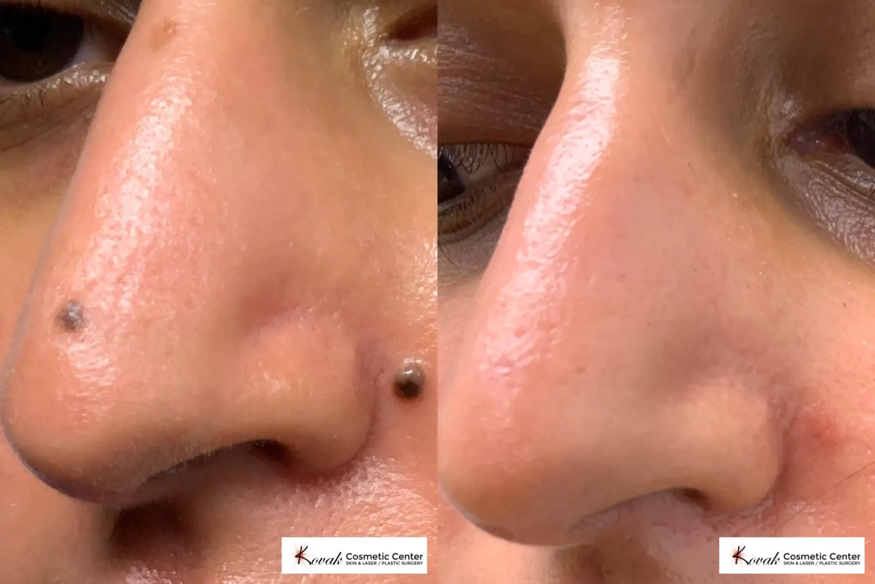 Mole Removal on a 30 year old female - Before and After  